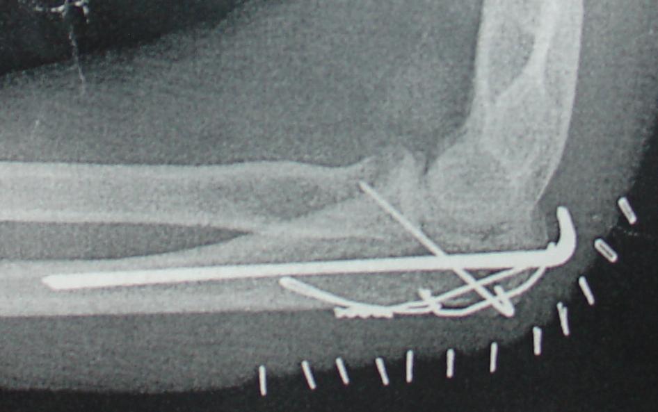 Shattered elbow X-ray