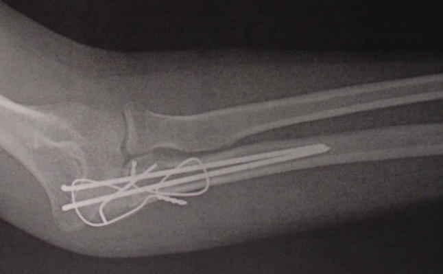 Shattered elbow X-ray